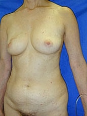 Breast Reconstruction Before & After