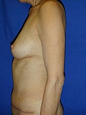 Breast Reconstruction Before & After