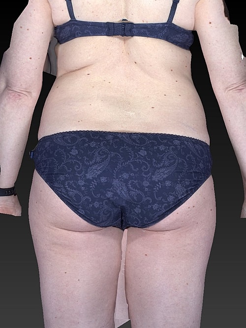 Liposuction Before & After