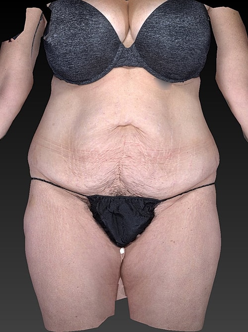 Liposuction Before & After