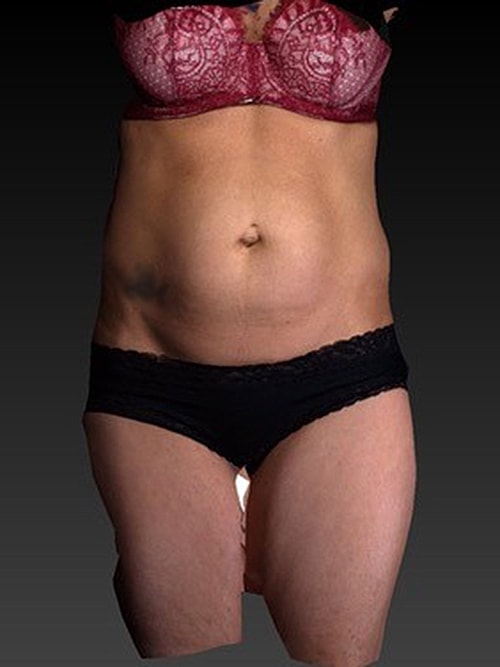 Liposuction Before & After