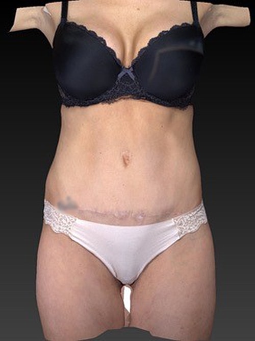 Liposuction Before & After