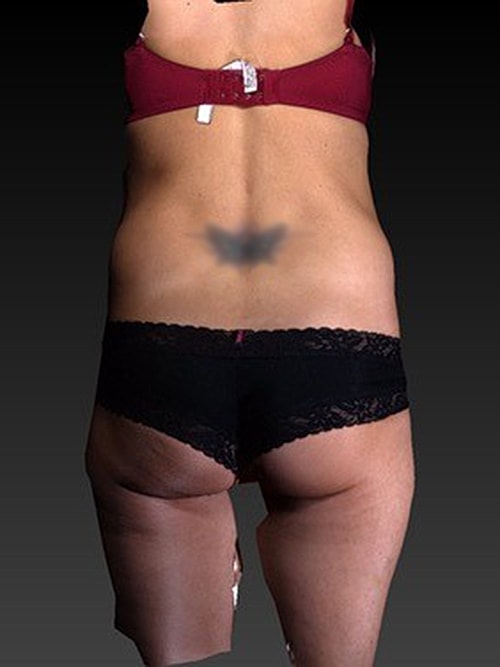 Liposuction Before & After