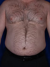 Liposuction Before & After
