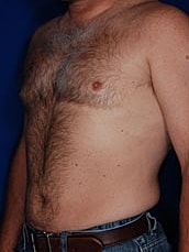Liposuction Before & After