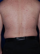 Liposuction Before & After