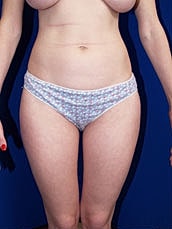Liposuction Before & After