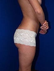 Liposuction Before & After