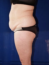 Liposuction Before & After