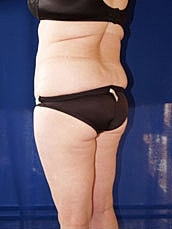 Liposuction Before & After