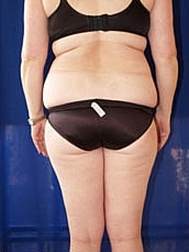 Liposuction Before & After