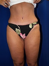 Liposuction Before & After