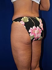 Liposuction Before & After