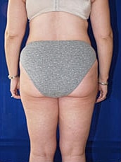 Liposuction Before & After