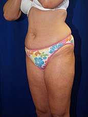 Liposuction Before & After