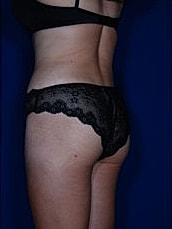 Liposuction Before & After