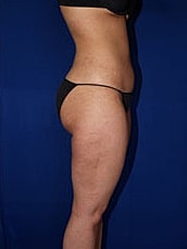 Liposuction Before & After