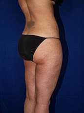 Liposuction Before & After