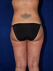Liposuction Before & After