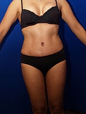 Liposuction Before & After