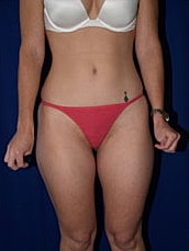 Liposuction Before & After