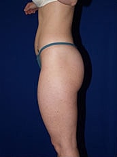 Liposuction Before & After