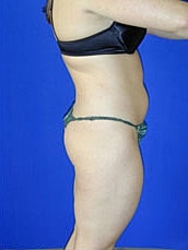 Liposuction Before & After