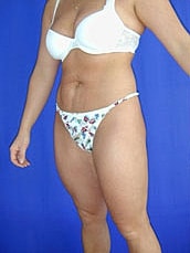 Liposuction Before & After