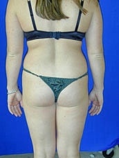 Liposuction Before & After