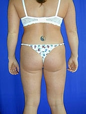 Liposuction Before & After