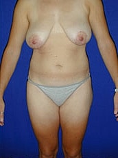 Liposuction Before & After