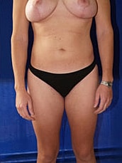 Liposuction Before & After