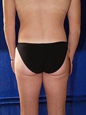 Liposuction Before & After