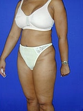 Liposuction Before & After