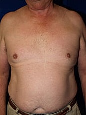 Liposuction Before & After
