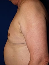 Liposuction Before & After