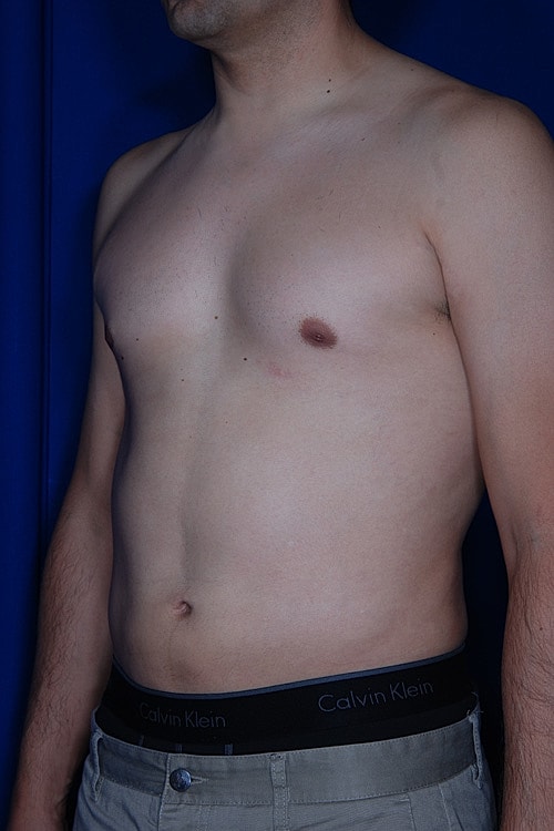 Liposuction Before & After