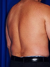 Liposuction Before & After