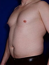 Liposuction Before & After