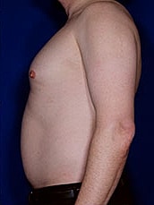 Liposuction Before & After