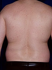 Liposuction Before & After