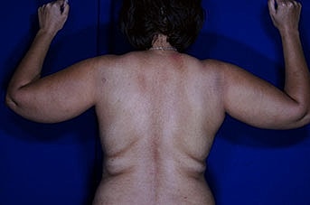 Liposuction Before & After