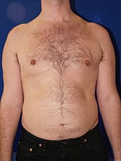 Liposuction Before & After
