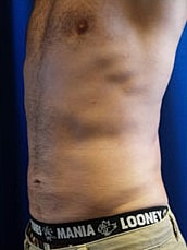 Liposuction Before & After