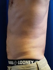 Liposuction Before & After