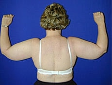 Liposuction Before & After