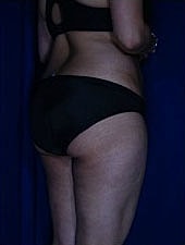 Liposuction Before & After