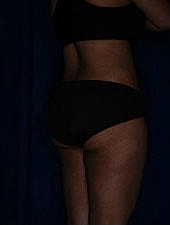 Liposuction Before & After