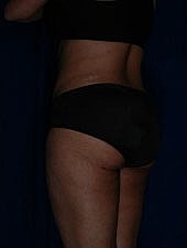 Liposuction Before & After