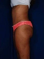Liposuction Before & After